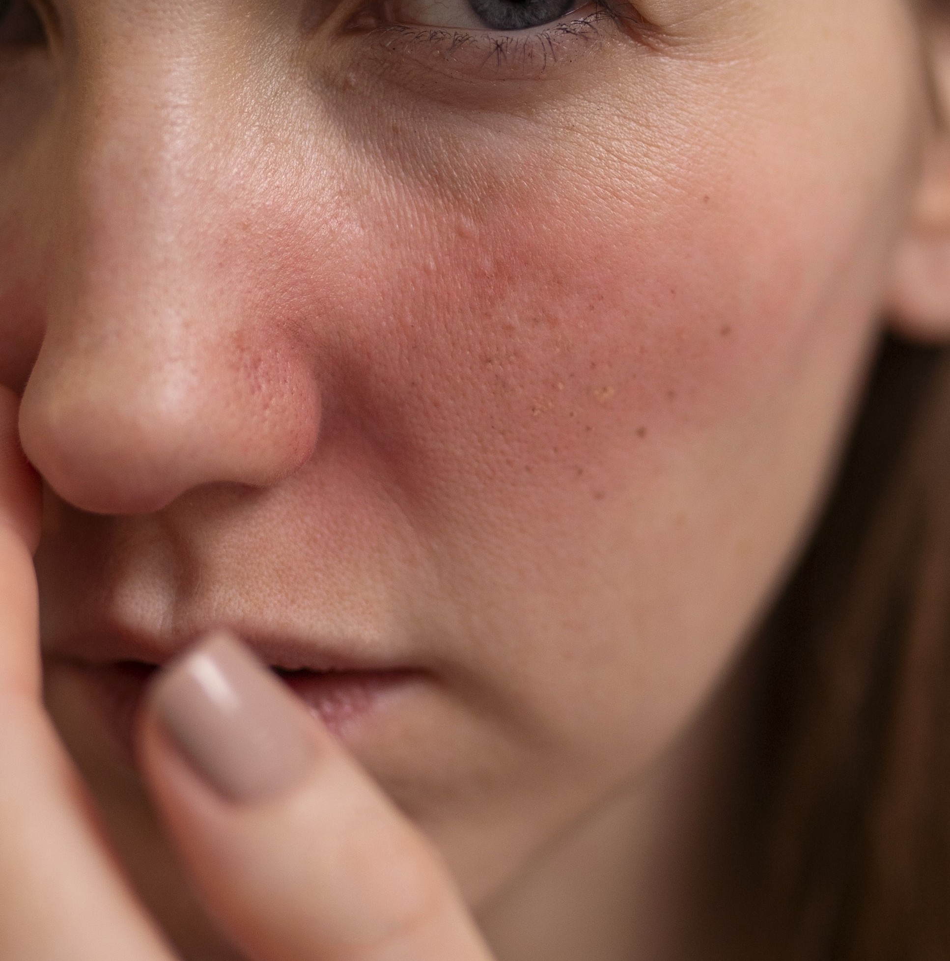 Rosacea Clinical Presentation